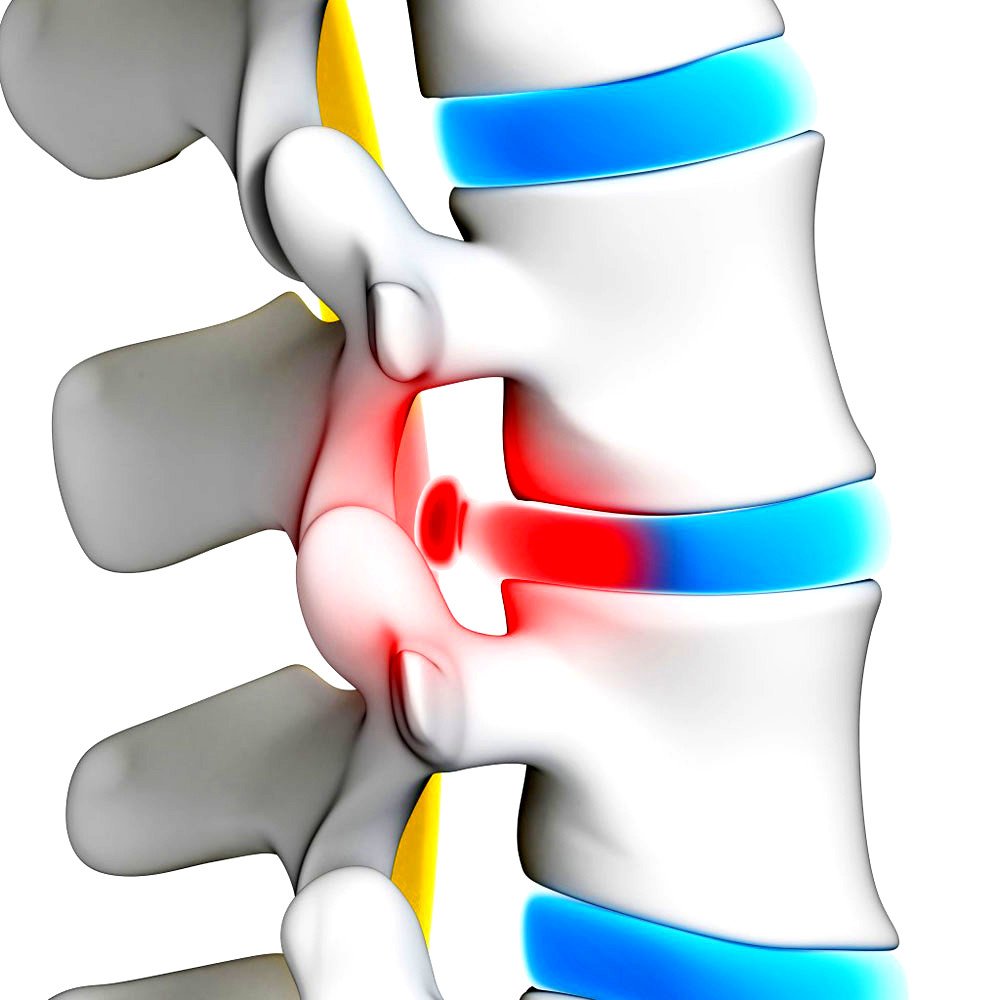Фото грыжи позвонка
