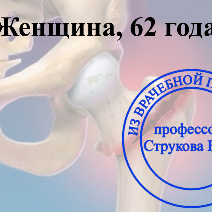 перелом шейки бедра требуется новый подход к лечению