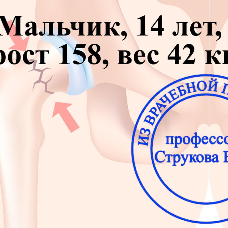 перелом шейки бедра