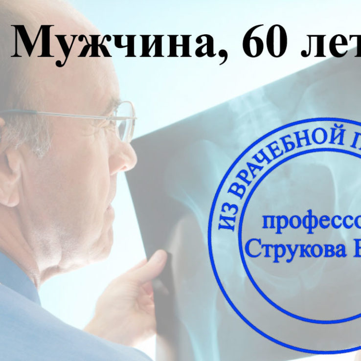 остеопороз 3 степени