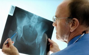 Изображение - Что такое остеопороз и остеоартроз суставов лечение osteoporoz-sustavov-300x186
