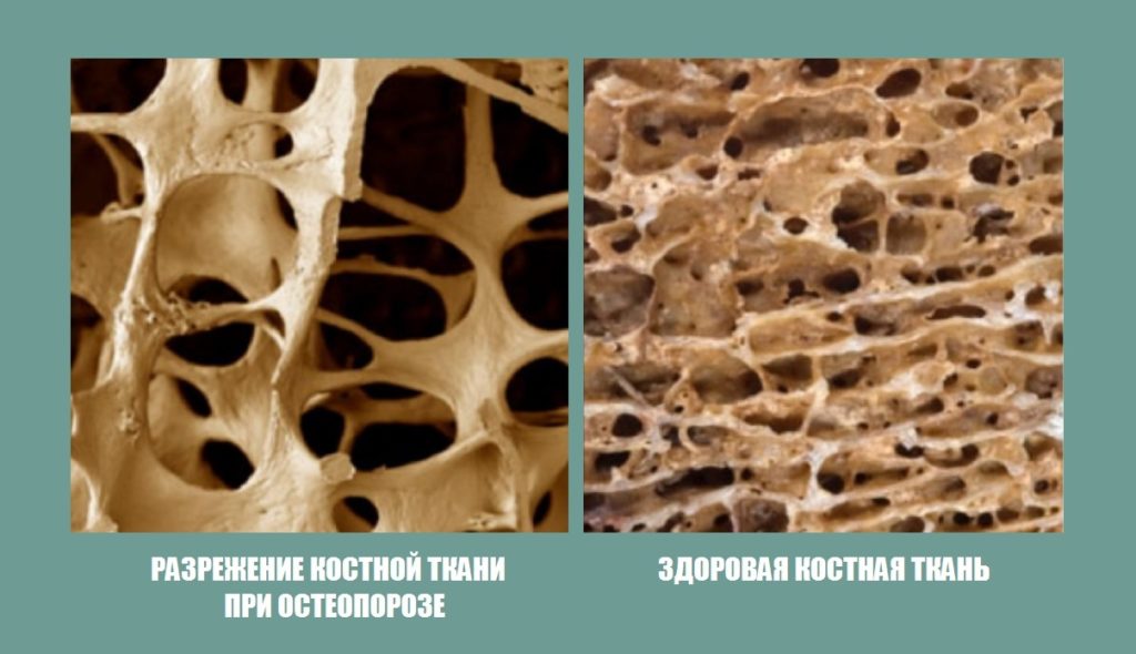 Костная ткань при остеопорозе