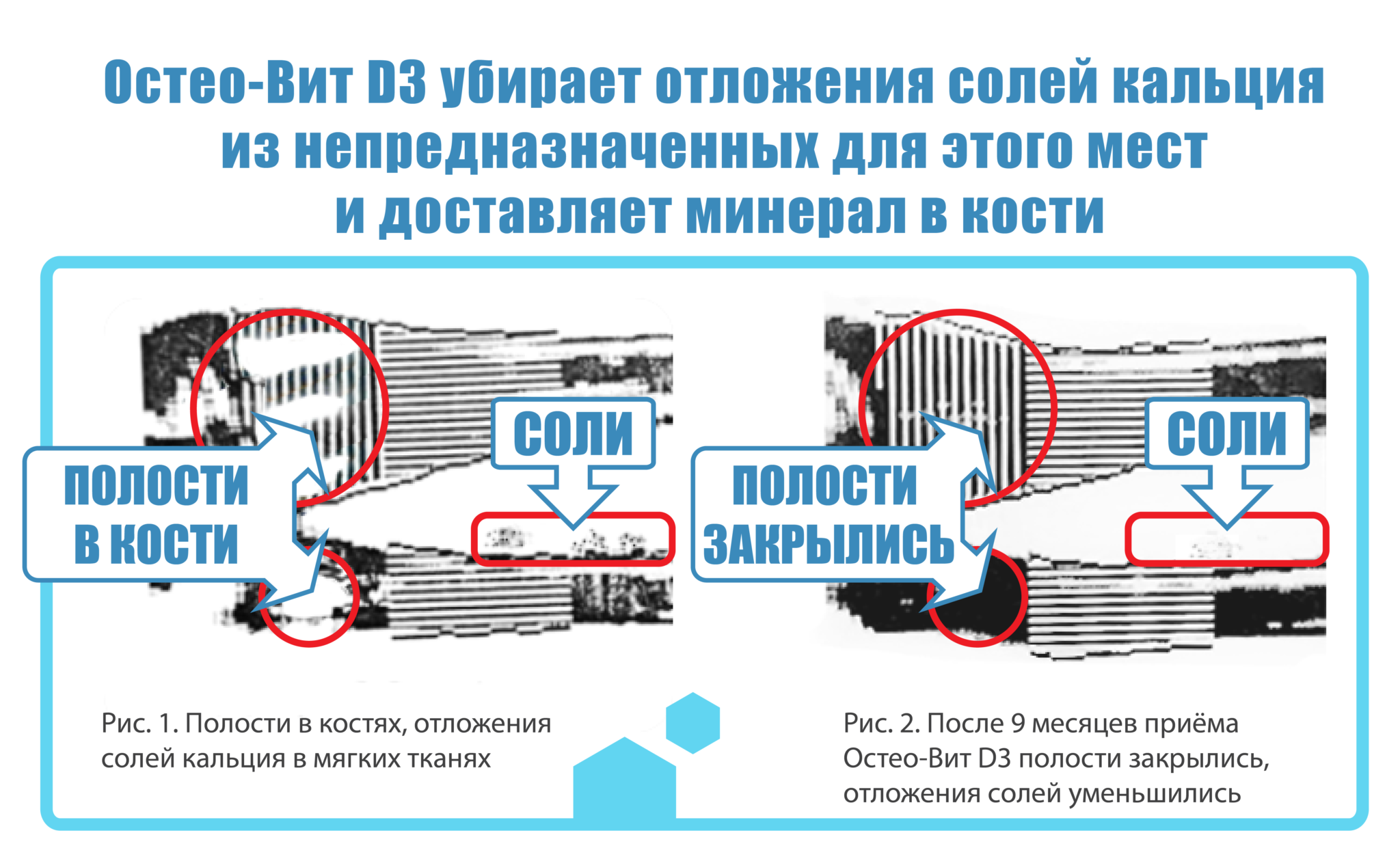 Отложение солей в тканях. Отложения солей на штангах. Солевые отложения в суставах.