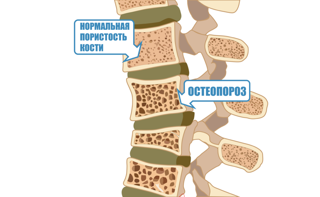 остеопороз