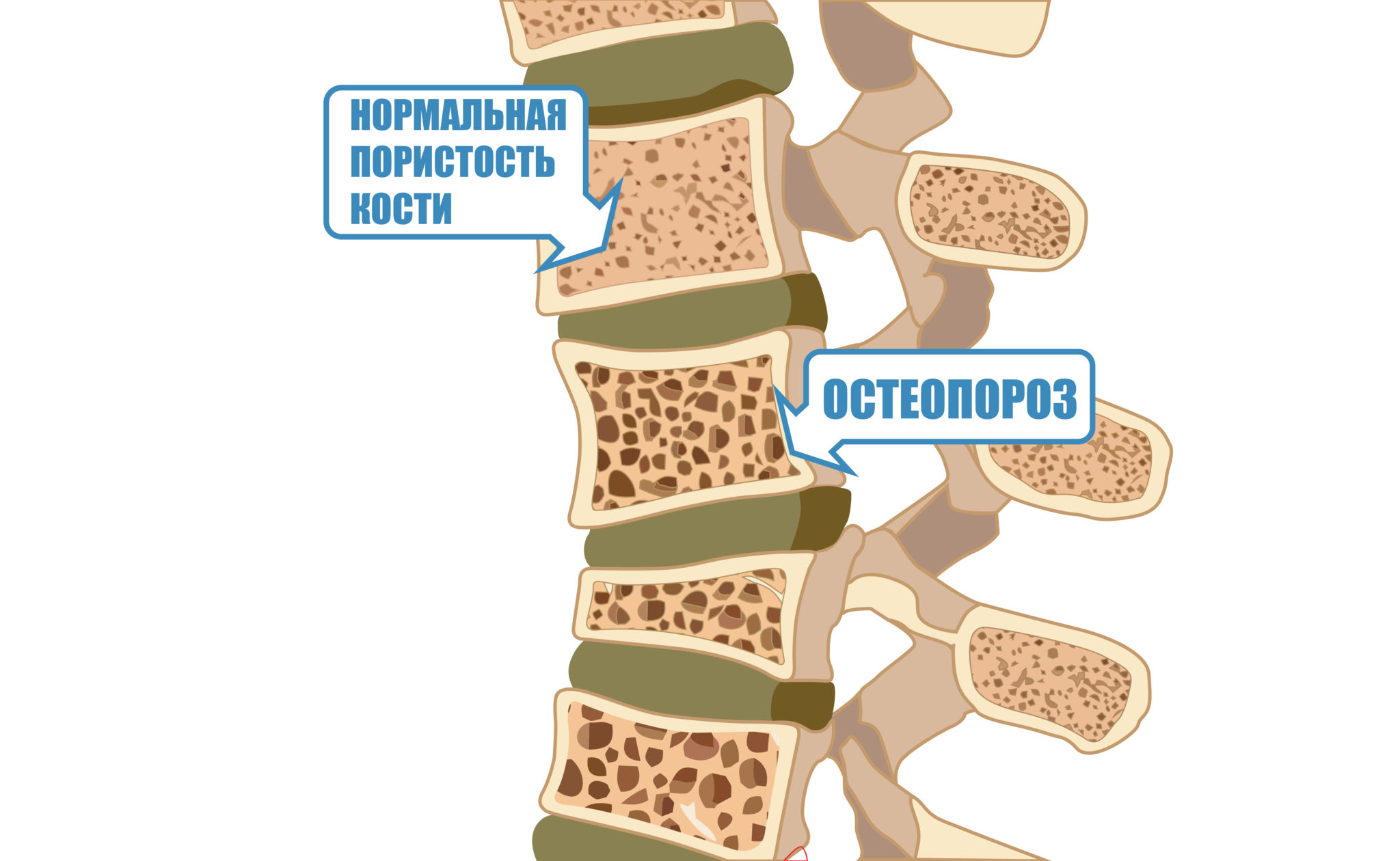 Поясничный остеопороз. Остеопороз и деминерализация костей. Остеопороз позвоночника поясничного отдела. Пятнистый остеопороз позвоночника. Остеопороз костей позвоночника.