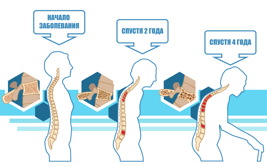Симптомы остеопороза позвоночника