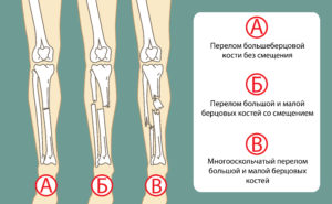 Методы лечение переломов берцовой кости