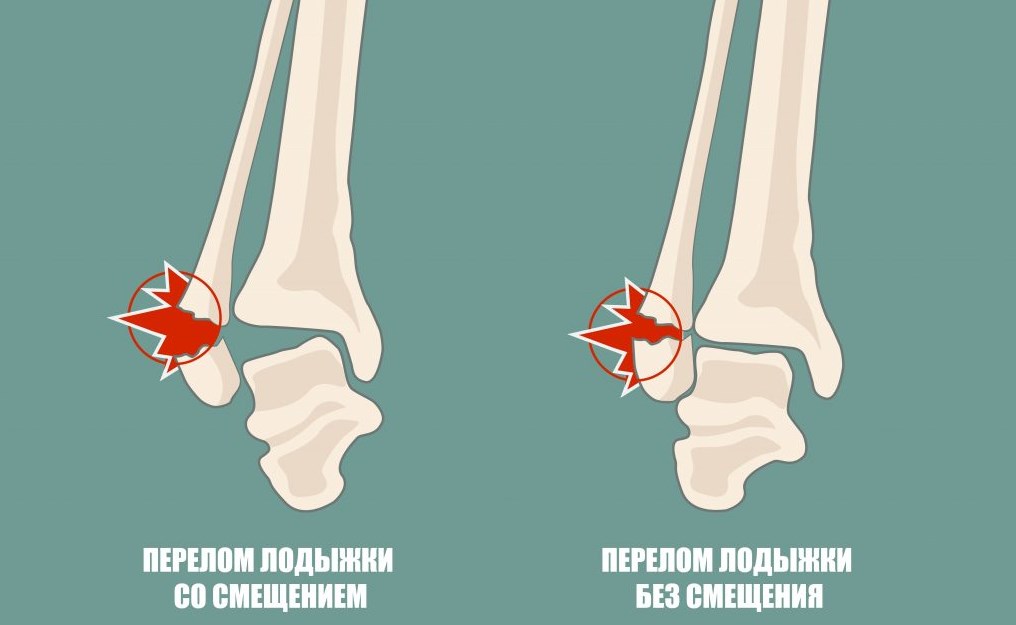 Что делать при переломе ноги щиколотки