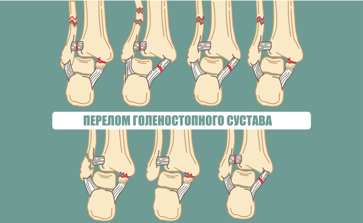 Как выглядит перелом голеностопа фото