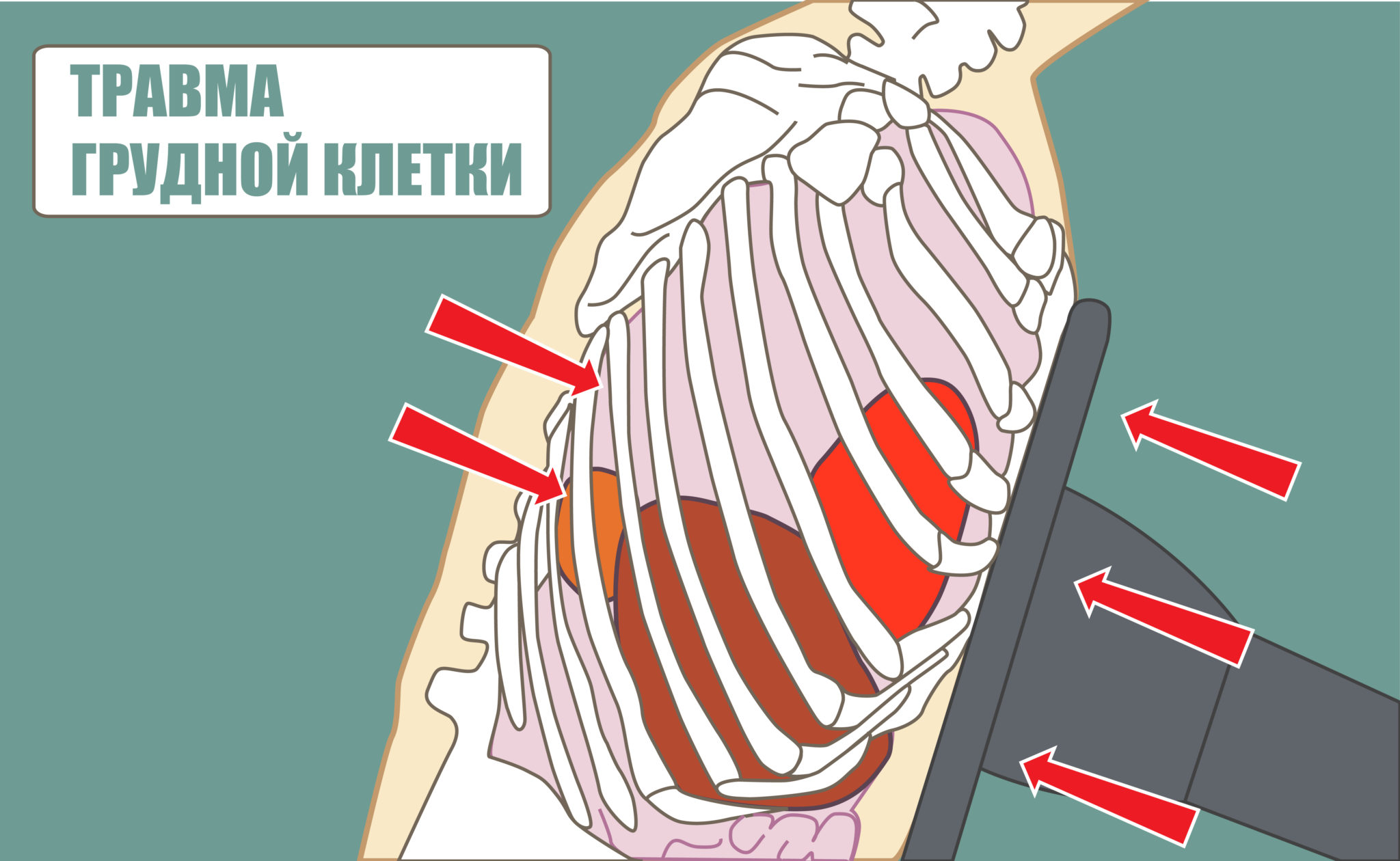 Перелом грудной клетки. Перелом костей грудной клетки. Перелом мечевидного отростка.