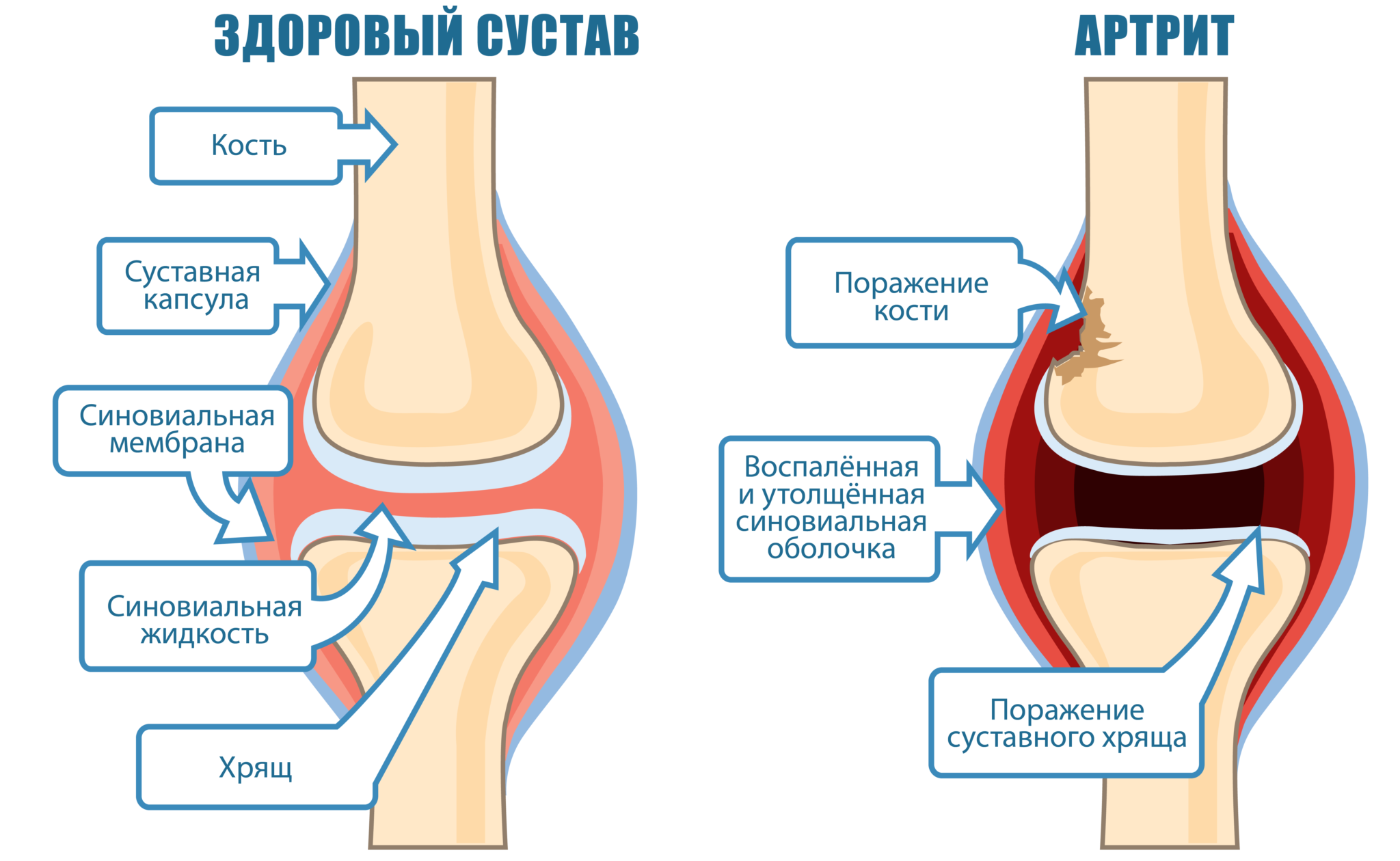 Что разрушает суставы. Костные остеофиты коленного сустава. Артроз коленного сустава. Костные разрастания в коленном суставе. Остеофиты коленного сустава.