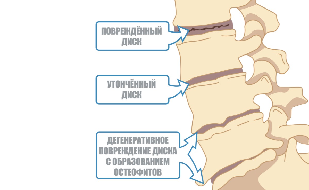 Остеохондроз поясничного отдела фото